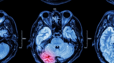 Doctor reviewing brain scan results after a car accident